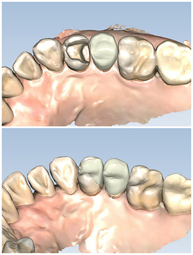 Before and after inlay repair for a damaged tooth