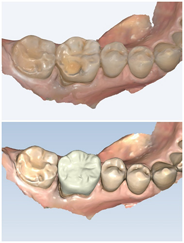 Pre-op intraoral scan used to design a same-day dental crown
