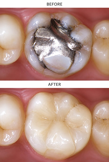Damaged tooth before receiving a ceramic onlay